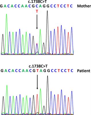 A New MAMLD1 Variant in an Infant With Microphallus and Hypospadias With Hormonal Pattern Suggesting Partial Hypogonadotropic Hypogonadism—Case Report